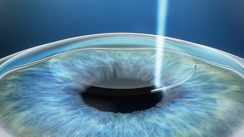 Smile Laser Eye Surgery 