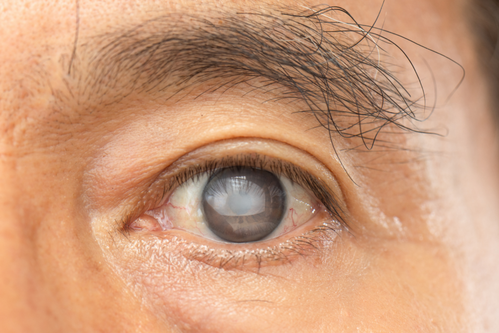 A close up of an eye with cataracts which will need premium cataract surgery